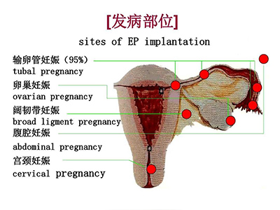 异位妊娠的诊疗